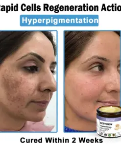 Turonu® Bee Venom Skin Treatment Cream