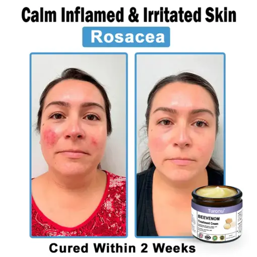 Turonu® Bee Venom Skin Treatment Cream
