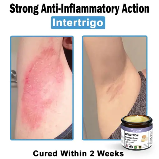Turonu® Bee Venom Skin Treatment Cream