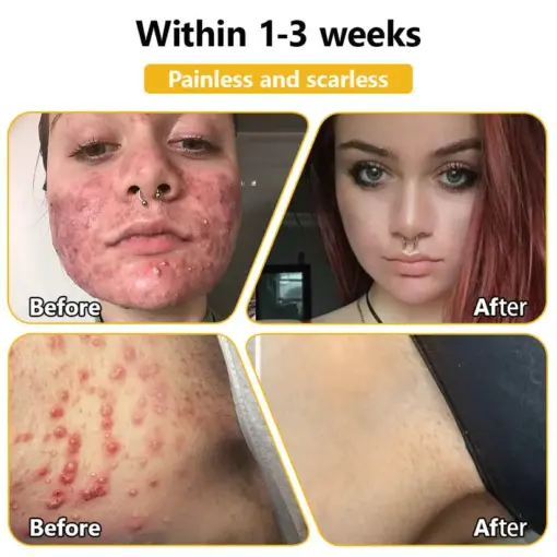 Turonu® Bee Venom Treatment Cream