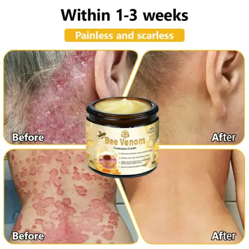 Turonu® Bee Venom Treatment Cream