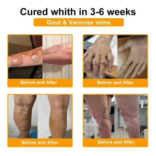 Turonu® Botulinum Toxin & Bee Venom Pain-Relief Bone Healing Cream