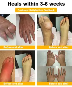 Turonu® Botulinum Toxin & Bee Venom Pain-Relief Bone Healing Cream