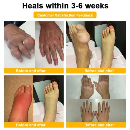 Turonu® Botulinum Toxin & Bee Venom Pain-Relief Bone Healing Cream
