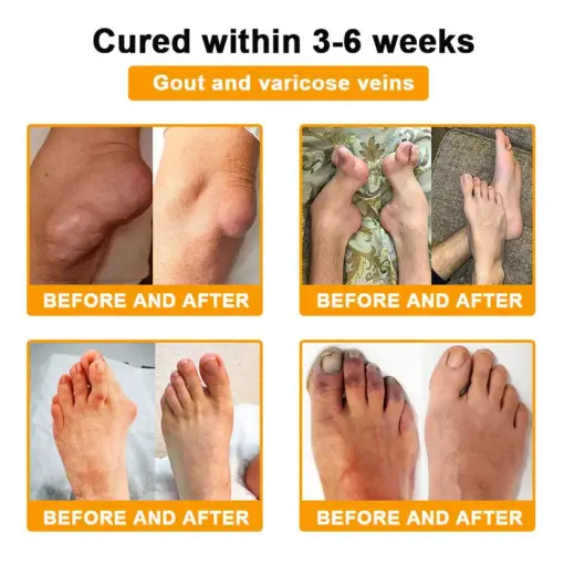 Turonu® Botulinum Toxin & Bee Venom Pain-Relief Bone Healing Cream