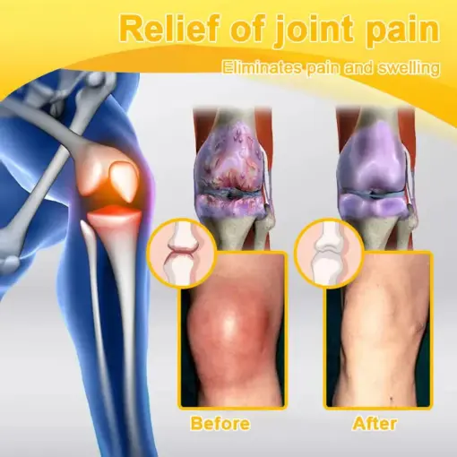 Turonu® Botulinum Toxin & Bee Venom Pain-Relief Bone Healing Cream