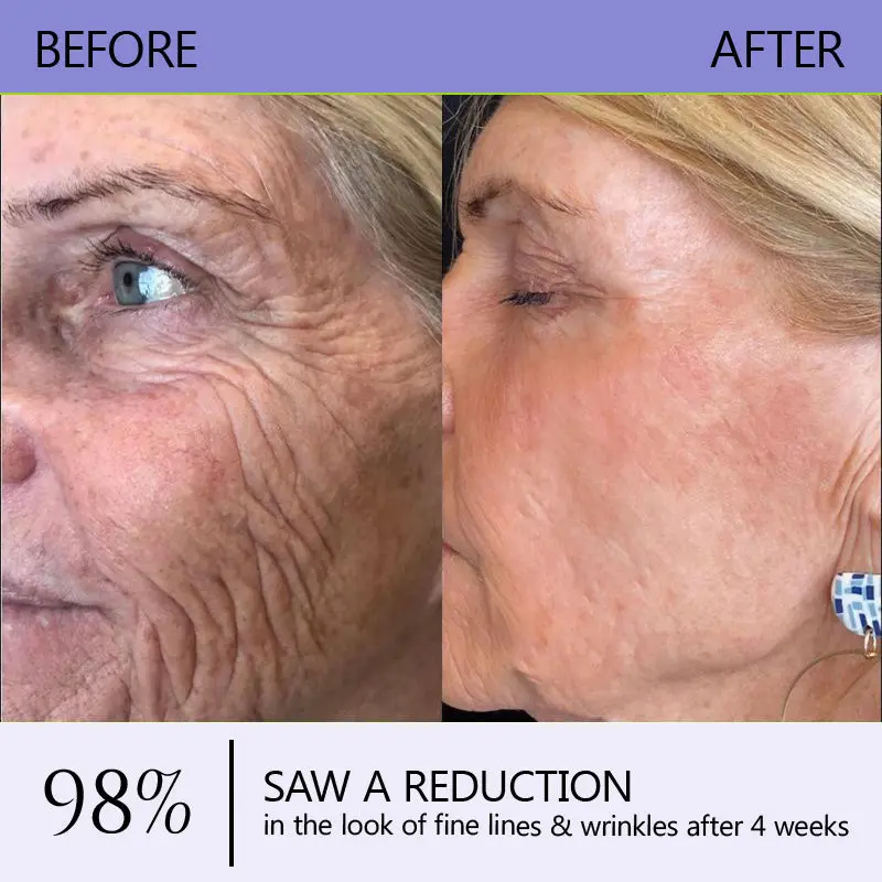 Turonu® Wrinkle-Reducing & Lifting Roller Cream