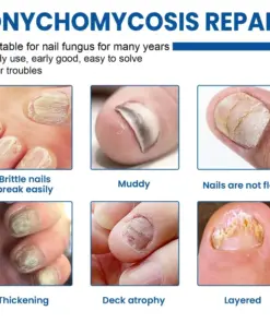 Turonu® NEW 2026 Nail Repair Patches Overnight Hydrogel Care For Stronger-Looking Nails